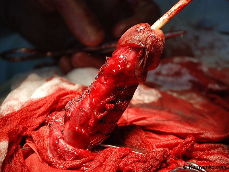 installation of a collagen matrix to enlarge the penis