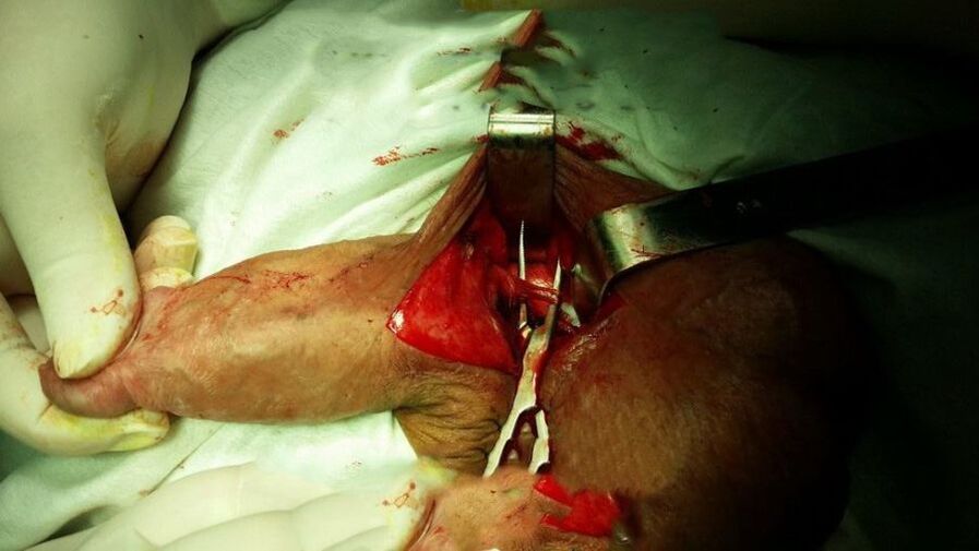 ligamentotomy to enlarge the penis