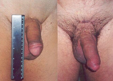 Penis length before and after enlargement surgery.
