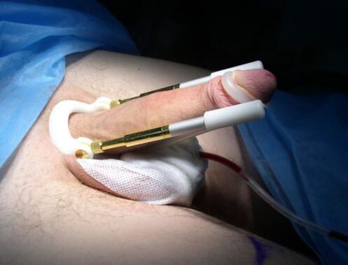 Using an extender after penis enlargement surgery.