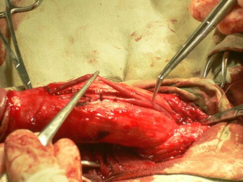 perform penis enlargement surgery